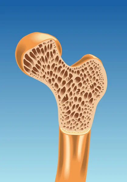 Colorido esquema de osteoporosis — Vector de stock