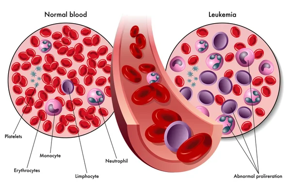 Esquema colorido de la leucemia — Vector de stock