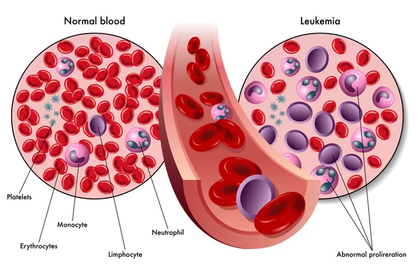 Esquema de leucemia colorida —  Vetores de Stock