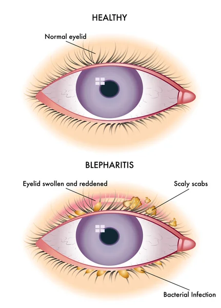 Kleurrijke blefaritis regeling — Stockvector