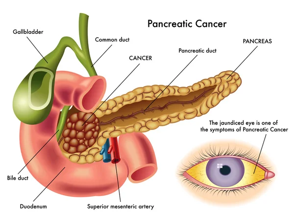 Schema del cancro al pancreas — Vettoriale Stock