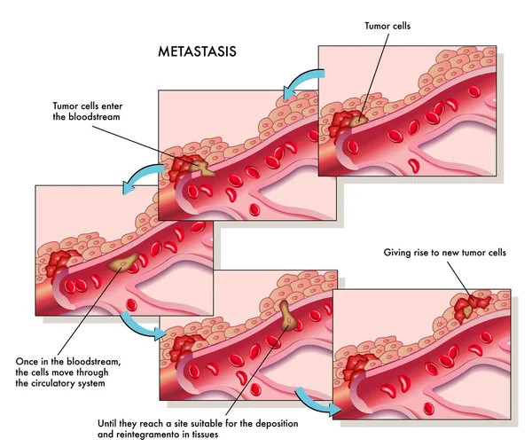 Schema di metastasi colorato — Vettoriale Stock