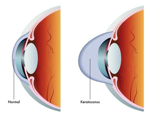 Esquema de Keratoconus colorido — Vetor de Stock