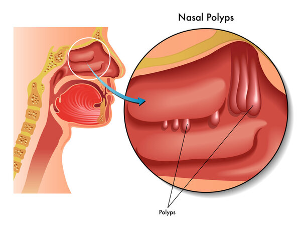 Nasal polyps scheme