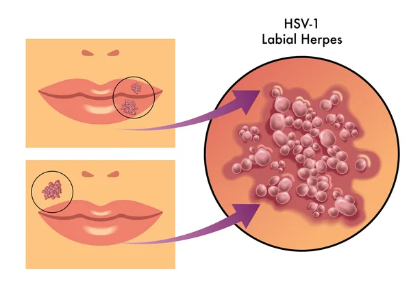 Labial herpes regeling — Stockvector