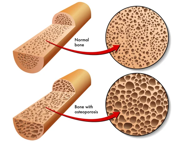 Colorido esquema de osteoporosis — Vector de stock