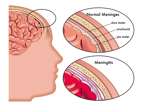 Meningitis Imágenes Vectoriales, Gráfico Vectorial de Meningitis | Depositphotos