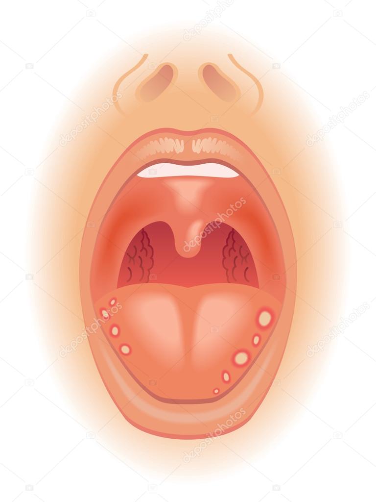 Tongue sores scheme