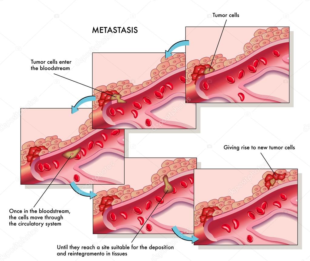 colorful Metastasis scheme