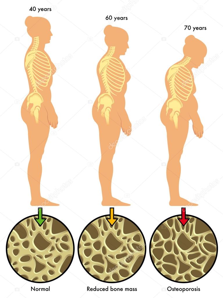 colorful Osteoporosis scheme