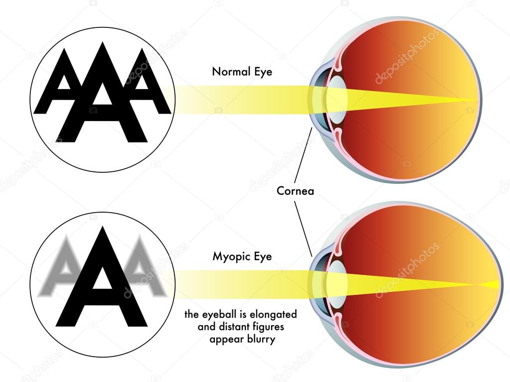 colorful Myopia scheme