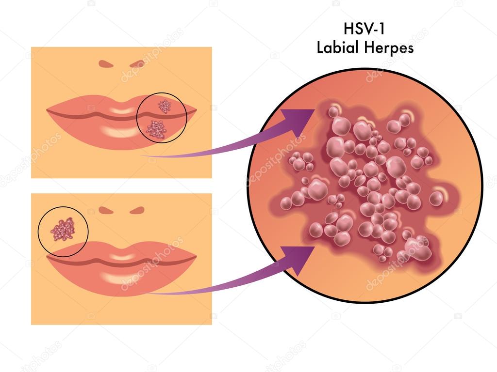 Virus del herpes simple imágenes de stock de arte vectorial | Depositphotos