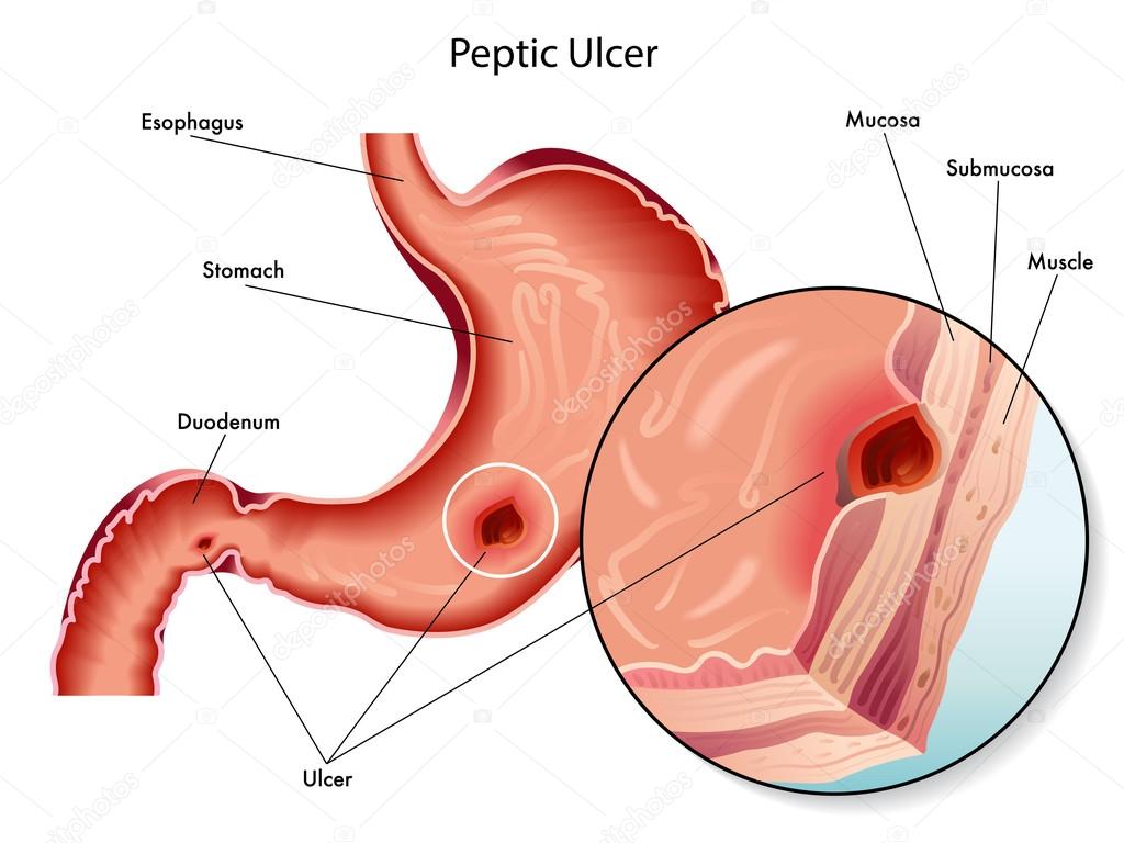 Peptic ulcer scheme