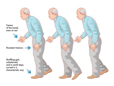 Parkinson's Disease scheme clipart