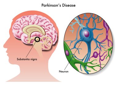 Parkinson hastalığı düzeni