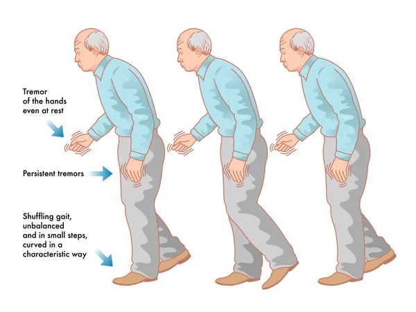 Esquema de la enfermedad de Parkinson — Archivo Imágenes Vectoriales