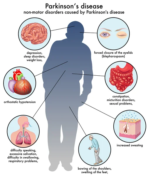 Esquema de la enfermedad de Parkinson — Archivo Imágenes Vectoriales