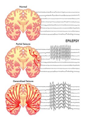 Human epilepsy scheme