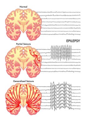Human epilepsy scheme clipart