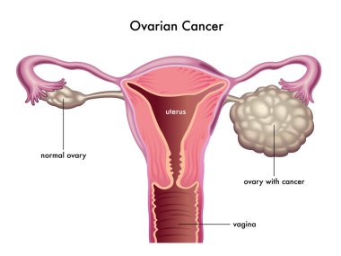 Ovarian cancer scheme