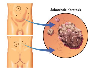 Seborrheic keratosis scheme