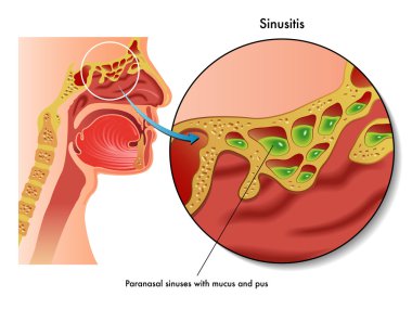 Human sinusitis scheme clipart