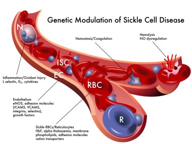 Sickle cell disease clipart