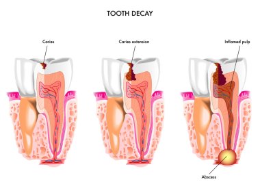 Tooth decay anatomy