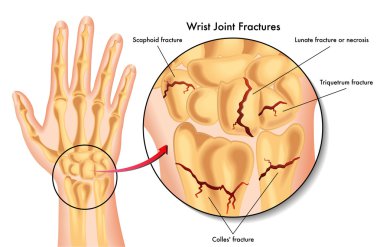 Wrist joint fractures