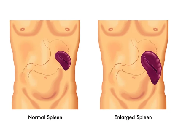 Human enlarged spleen — Stockvector