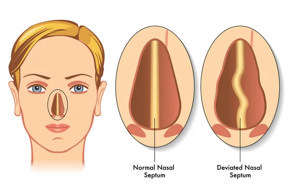 Deviated nasal septum — Stock Vector