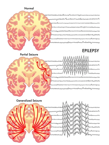 Human epilepsy scheme — 图库矢量图片