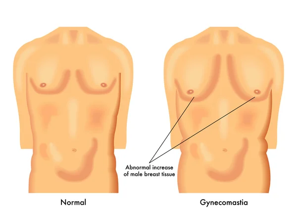 Human Gynecomastia scheme — Stock Vector