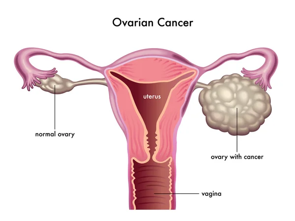 Ovarian cancer scheme — Stock Vector