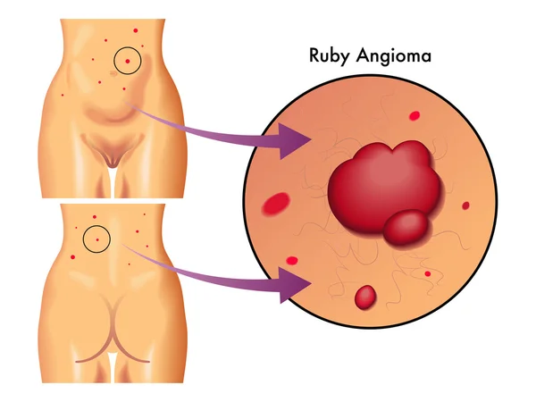 Ruby angioma scheme — Stock Vector