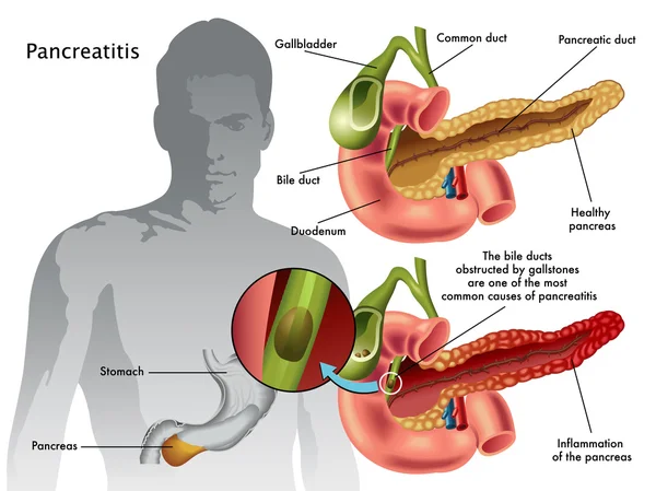 Human pancreatitis scheme — Stock Vector