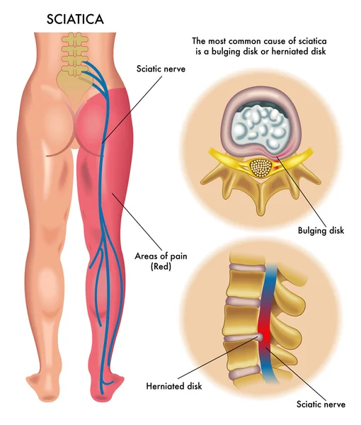 Human sciatica scheme — 图库矢量图片