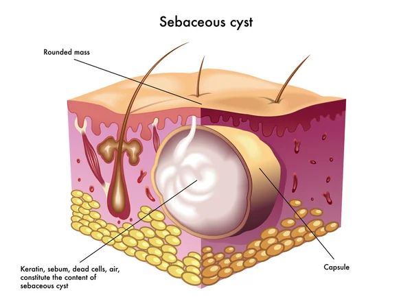 Sebaceous cyst scheme — Stock Vector