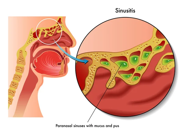 Human sinusitis scheme — Wektor stockowy