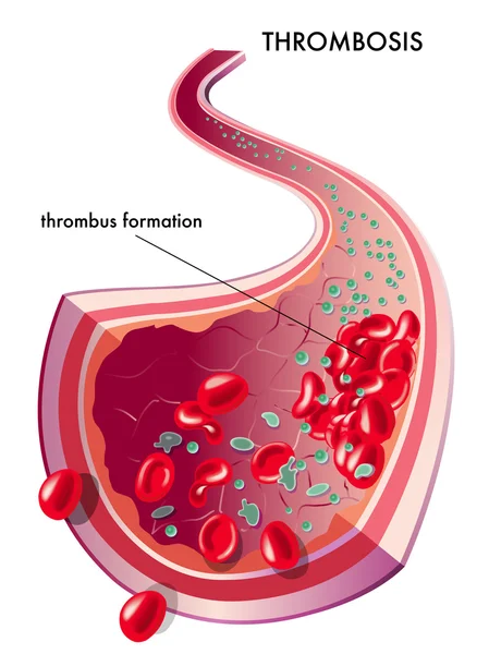 Human thrombosis scheme — Stock Vector