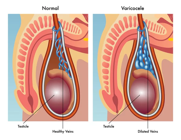 Anatomia varicocele umana — Vettoriale Stock