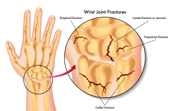 Wrist joint fractures — 图库矢量图片