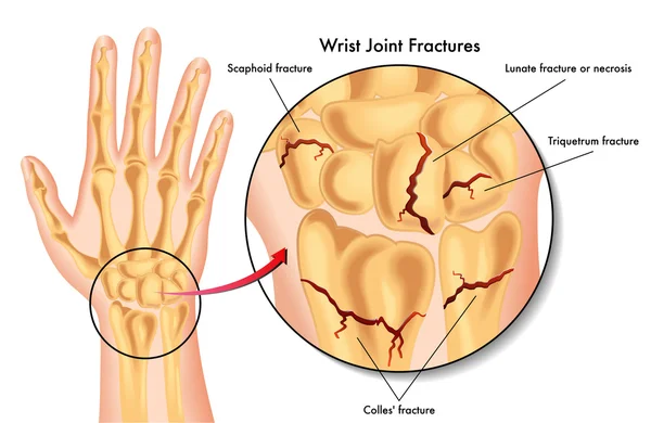 Wrist joint fractures