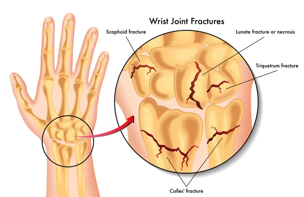 Fracturas articulares de muñeca — Archivo Imágenes Vectoriales
