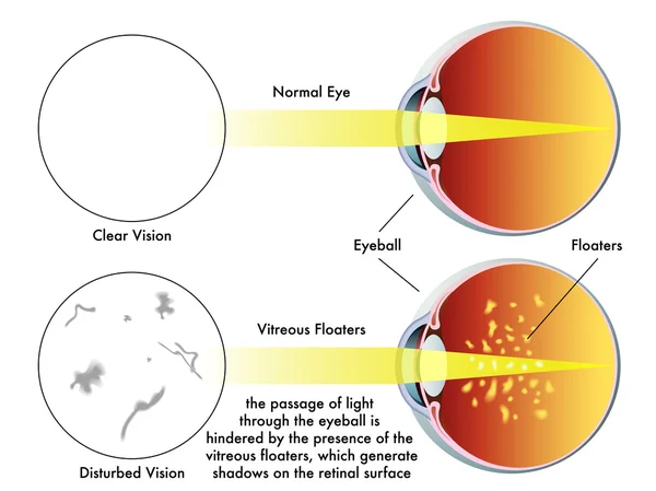 Natural Remedies to Reduce Eye Floaters