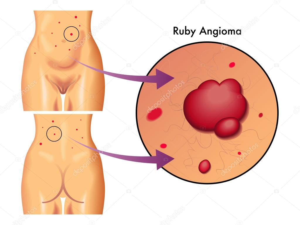 Ruby angioma scheme