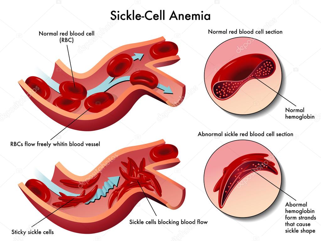 Sickle cell anemia