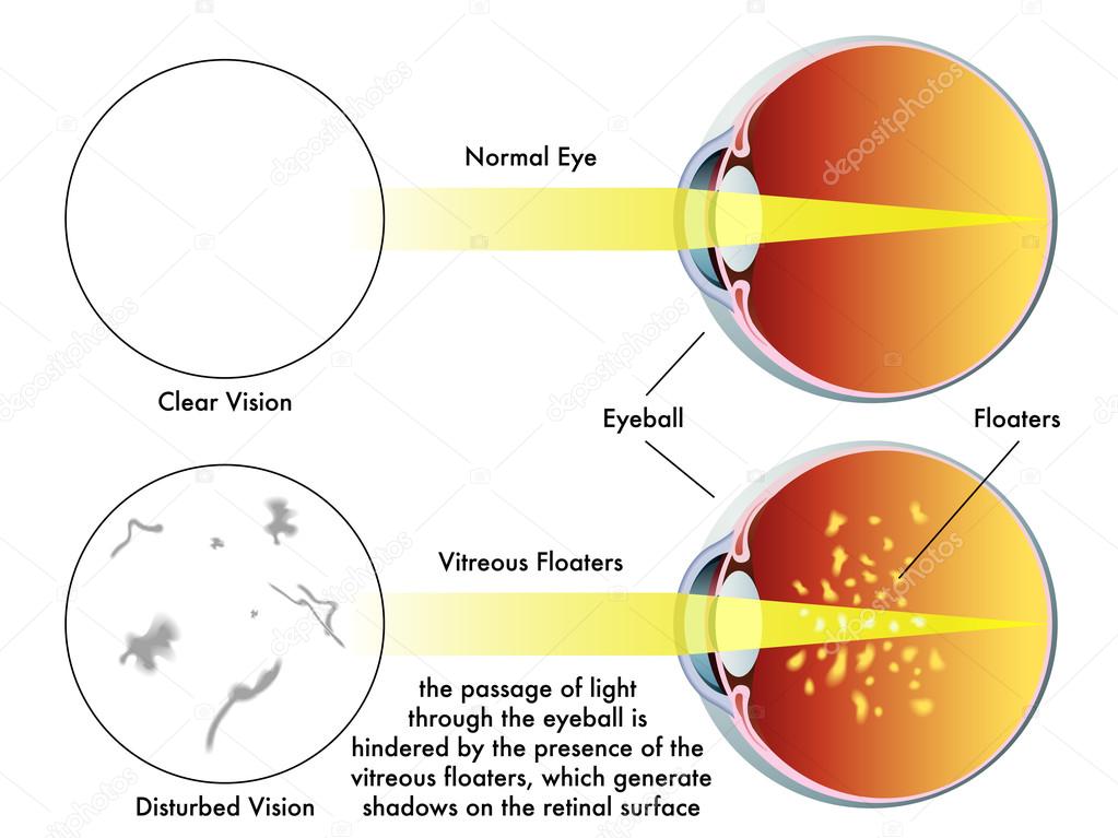Human vitreous floaters