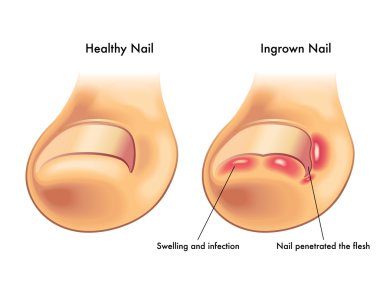 Medical illustration of the symptoms of ingrown nail clipart