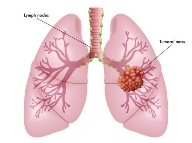 illustration of the symptoms of lung cancer clipart